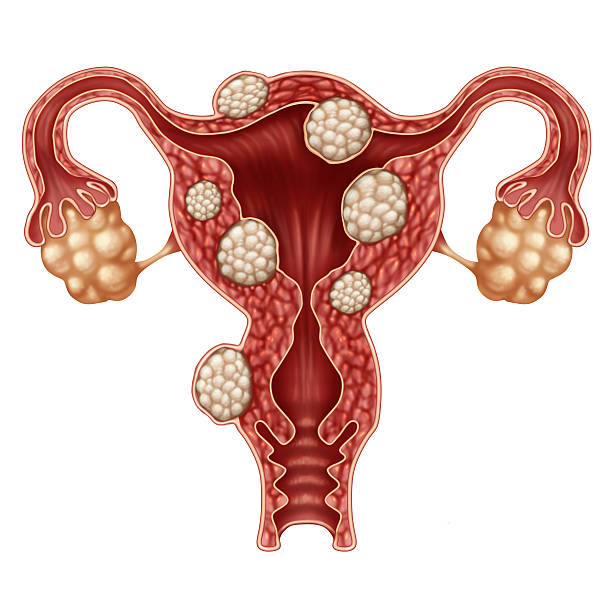 uterus_removal